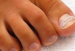 Kuvassa varpaankynsi oikaisuhoidossa