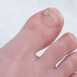 Kuvassa taaksepäin taittunut varpaankysni