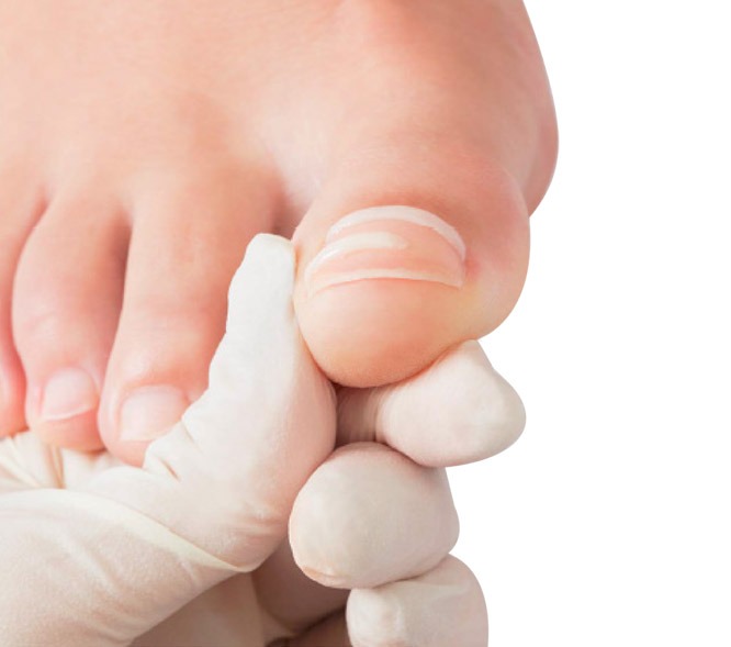 Lääkäri tarkastaa lateksihansikkaat käsissään potilaan varpaita